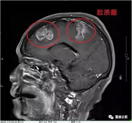 脑脓肿增强扫描是环形强化吗,脑部脓肿