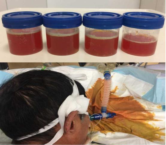 慢阻肺伴有急性加重能活几年,慢阻肺为什么会流鼻水