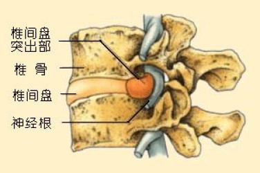 腰椎骨质增生的正确推拿按摩教程,腰椎骨质增生推拿按摩能治好吗