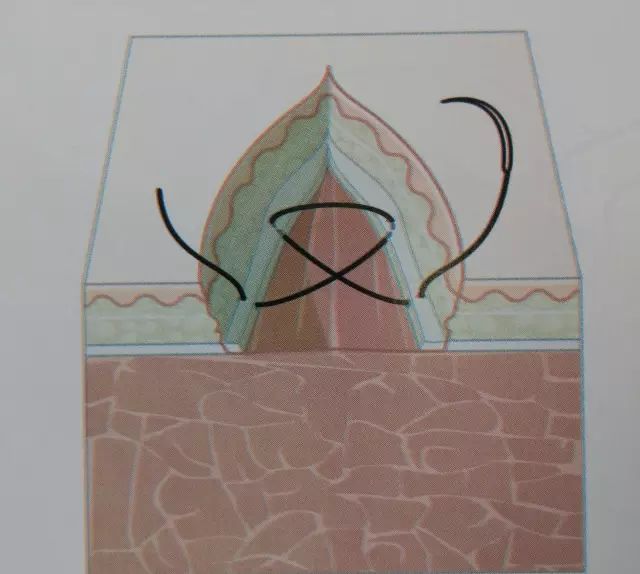 刀口闭合需要多久,伤口闭合除了缝针还有什么方法