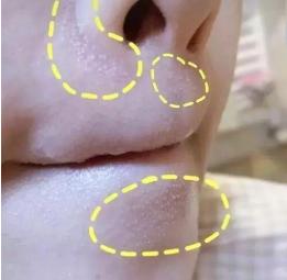 嘴下巴长痘快速消失的办法,36岁下巴长痘如何根治