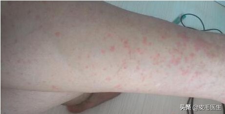 喝中药治疗荨麻疹反而严重了,防风能治荨麻疹吗