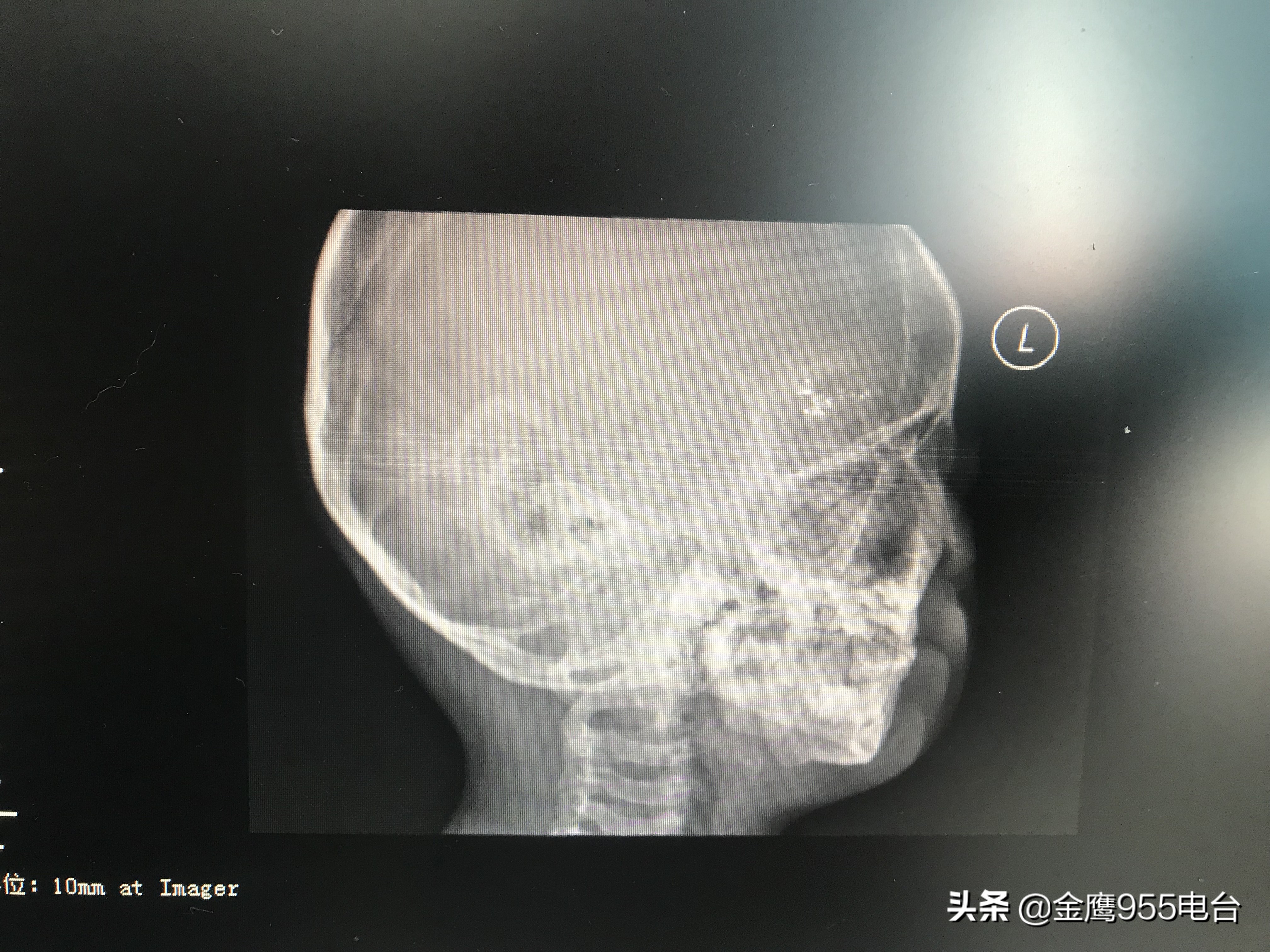 家长关注了！男孩不慎摔倒温度计插入眼眶三年驱汞治疗仍有残余