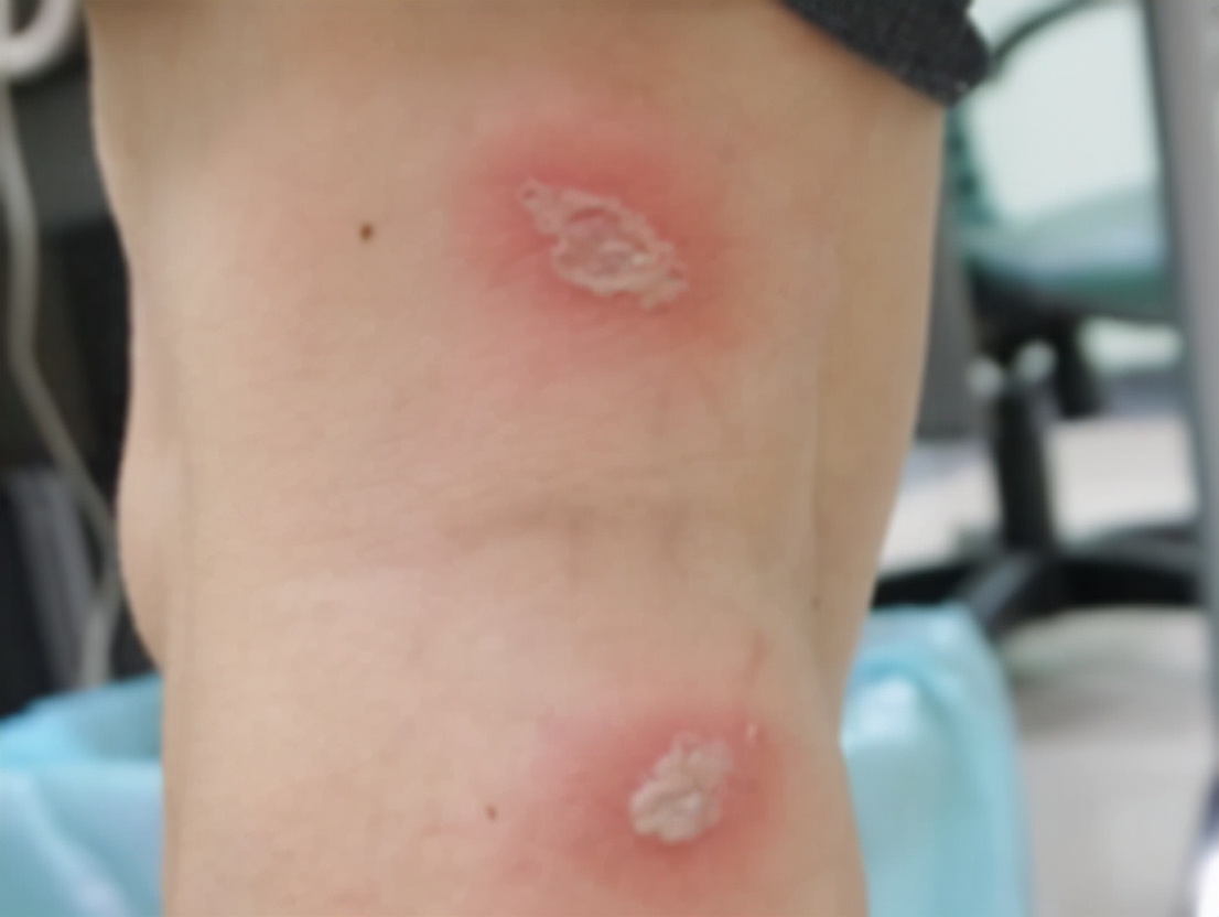 被隐翅虫毒液沾到涂什么药膏,被隐翅虫咬伤特效药