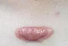 以前不是疤痕体质现在怎么留疤了,受伤了愈合之后为什么会留疤