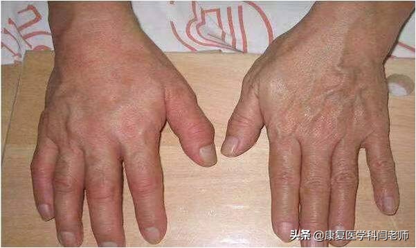 脑卒中后偏瘫患者常见并发症：肩手综合征的康复治疗