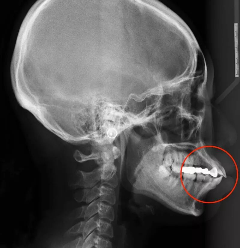 被嘴毁掉的颜值,如何挽救嘴突