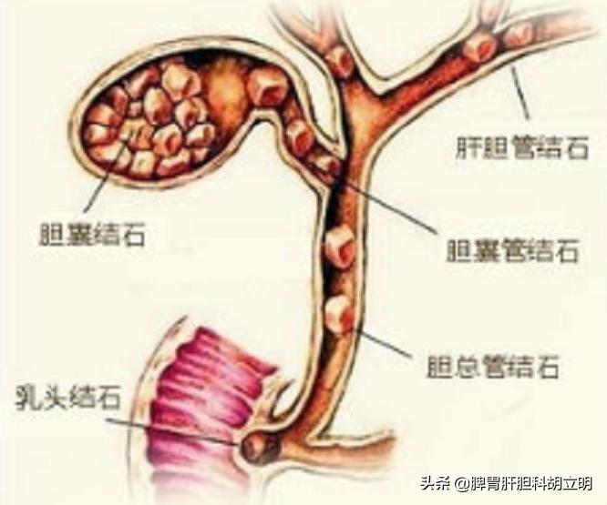 为什么会得胆结石如何预防胆结石,胆结石为什么会发作