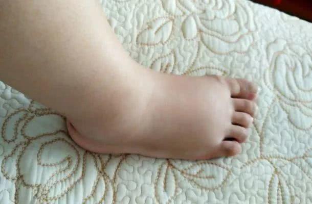 孕妇贫血会导致水肿吗,孕期贫血会水肿吗