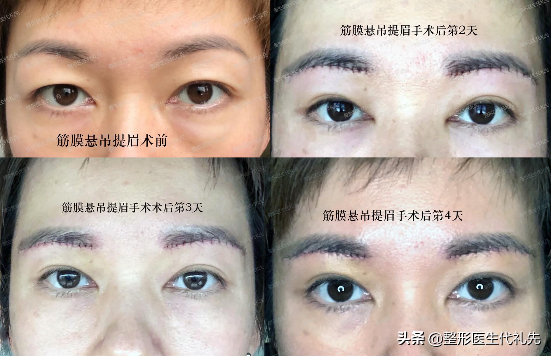 眼睑松弛下垂最佳解决方法,上眼皮松弛显老视频