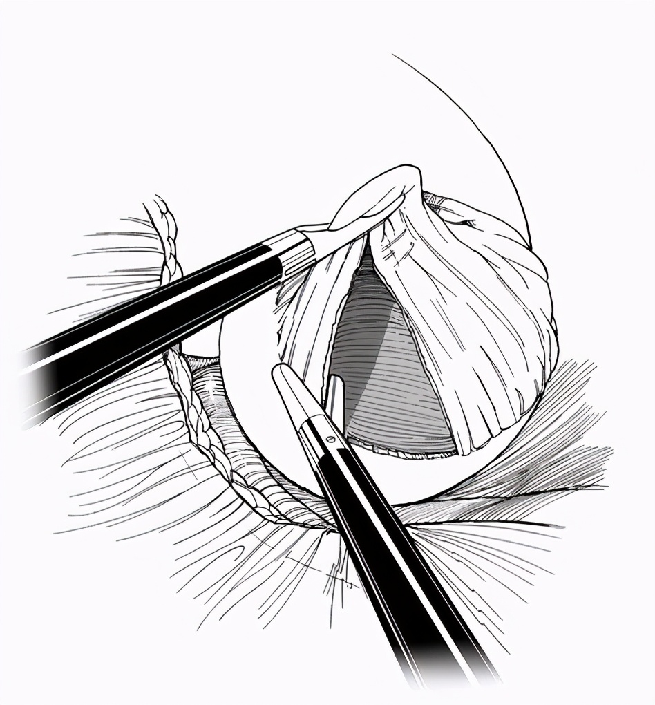 肾囊肿到底是怎么回事啊严不严重,了解肾囊肿最佳治疗方法是什么