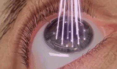 扔掉近视眼镜,以色列纳米眼药水啥时候上市