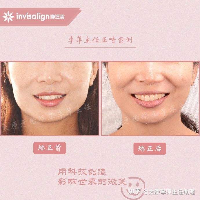 太原牙齿矫正靠谱吗,太原成人隐形牙套牙齿不齐