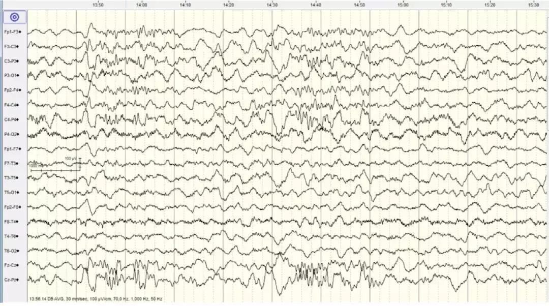 生酮初期症状及治疗方法,生酮饮食的疾病断根方法