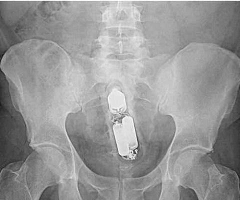 不作死就不会死,看看这些被人类搞进身体里的异物