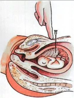 引产关注事项及流产要关注什么,引产简单解释