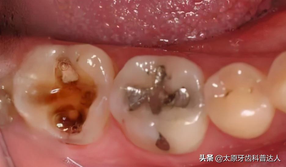 蛀牙是被虫子吃空的吗,蛀牙的虫子是什么样的