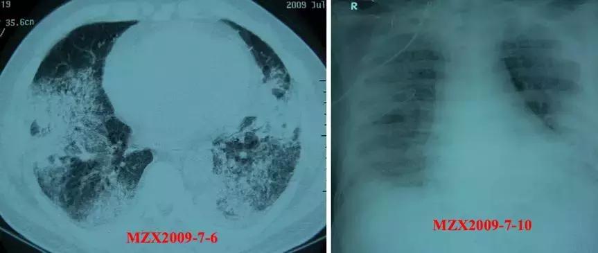 机化性肺炎平时应关注什么,机化性肺炎的正规治疗