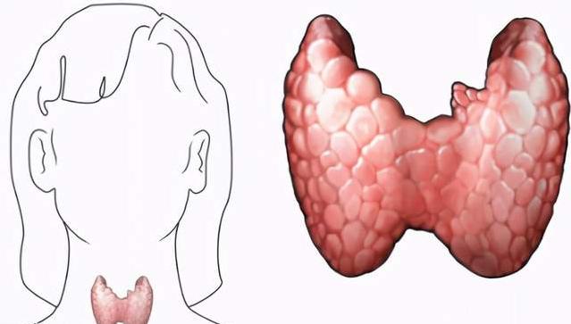 甲状腺结节你不得不知的三个问题,甲状腺结节其实没那么可怕