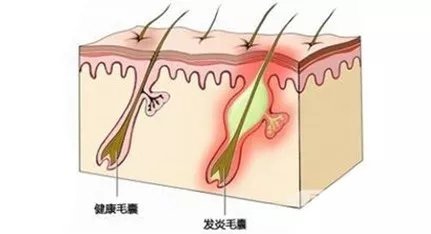 头皮上长疙瘩是什么原因,头皮上长疙瘩什么原因引起的