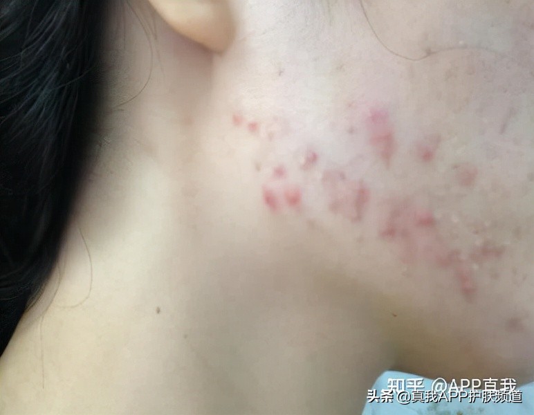 刷酸应该怎么刷,刷酸应该去医院的什么科室