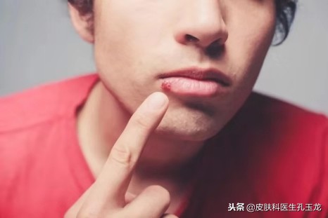 皮肤科常见疾病：嘴唇上火的真相——单纯疱疹