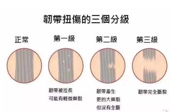 辟谣：踝关节扭伤是小病？看完最新治疗指南，你不这样想