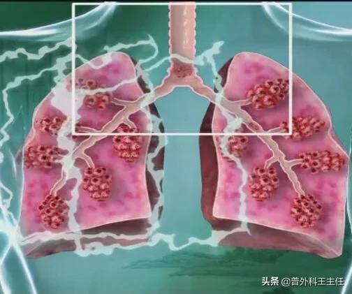 戒烟后咳嗽吐白痰是怎么回事,我戒烟2个月为什么咳嗽很厉害