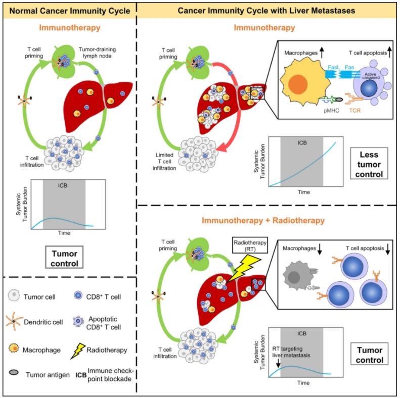 肝转移癌放疗效果好吗,转移肝肿瘤放疗有效吗