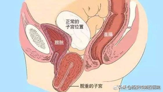 预防子宫脱垂患者的运动,产后如何预防子宫脱垂