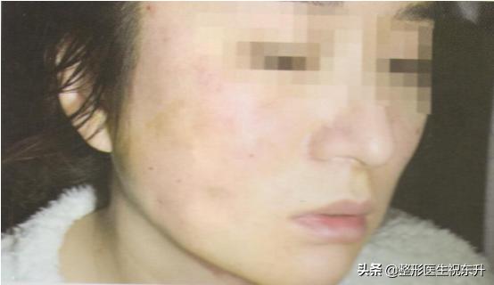 做了线雕为什么脸会肿,做了线雕为啥会越来越难看