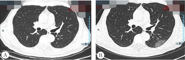新型冠状病毒感染的肺炎,CT有何特点?和其他病毒性肺炎有何区别