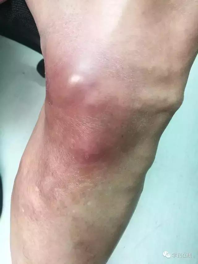 挤火疖子脓包有多痛,挤火疖子会往血管里爆吗