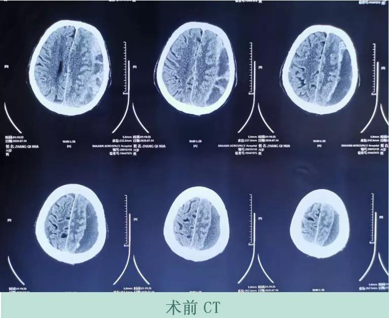 摔跤后有脑血肿怎么处理,轻微摔伤怎么处理