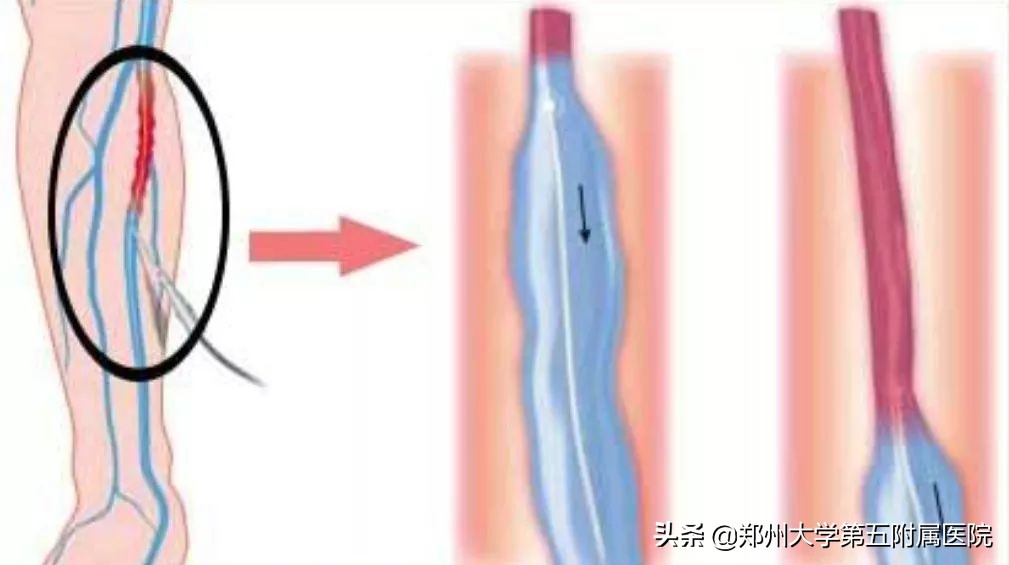 静脉曲张远离老烂腿,下肢静脉血管曲张怎么办