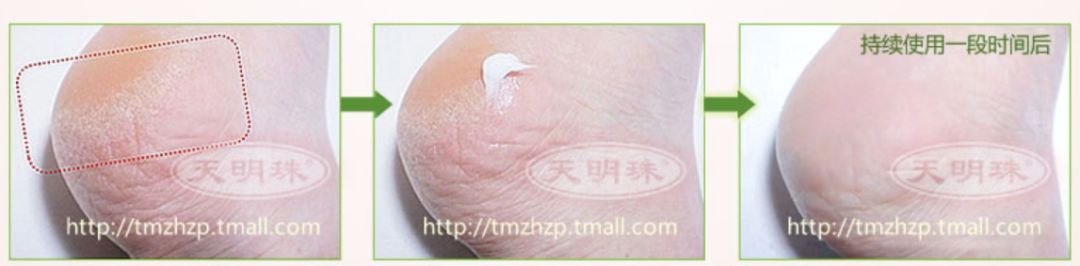 冬天脚后跟干裂用什么润脚霜,润足脚后跟干裂修复霜