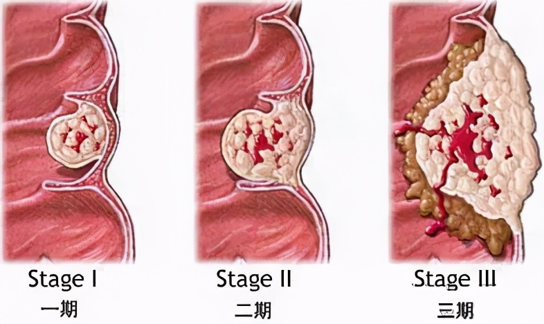 肠癌手术吻合口隆起复发,肠癌手术后再次复发还能治好吗