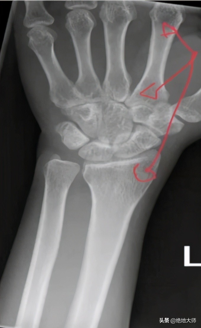 手神经外伤康复视频,治疗手神经损伤的药