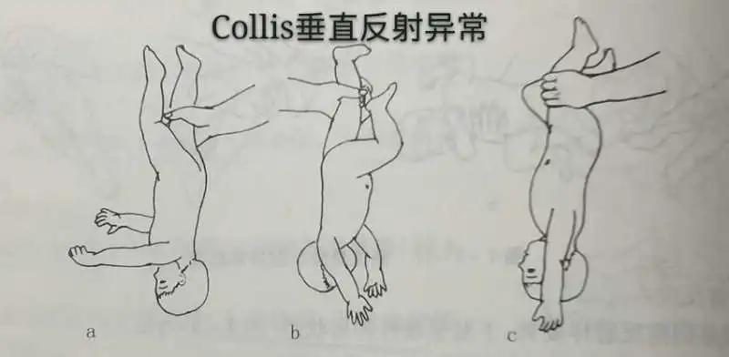 脑瘫儿童的七种异常姿势,判断宝宝脑瘫最简单的方法