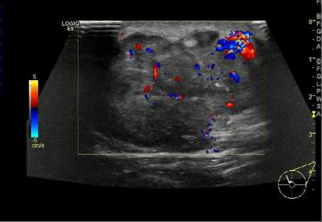 乳腺彩超报告中隐藏的秘密,乳腺结节4a怎么判断良性还是恶性
