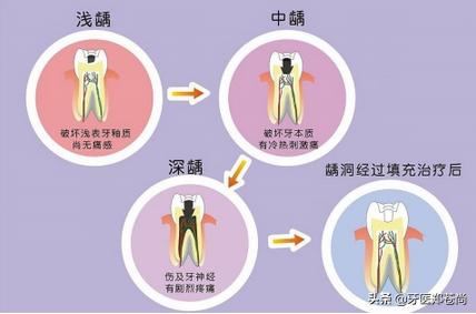 蛀牙已经烂空了只剩下牙根多少钱,蛀牙补好后牙根疼怎么办