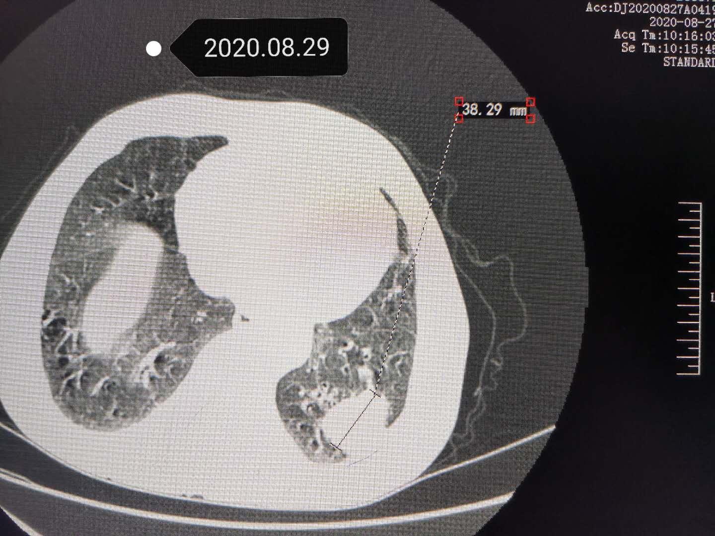 老人肺癌胸疼,外科王医生肺癌