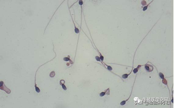 检查精子dna碎片报告怎么看,精子检查哪几项才知道是不是正常