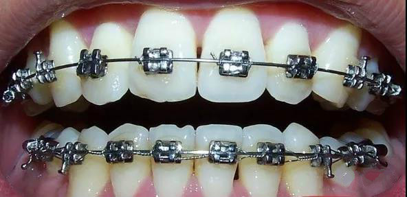 就两颗下排门牙不齐建议矫正吗,下牙不齐除了牙套还有什么方法