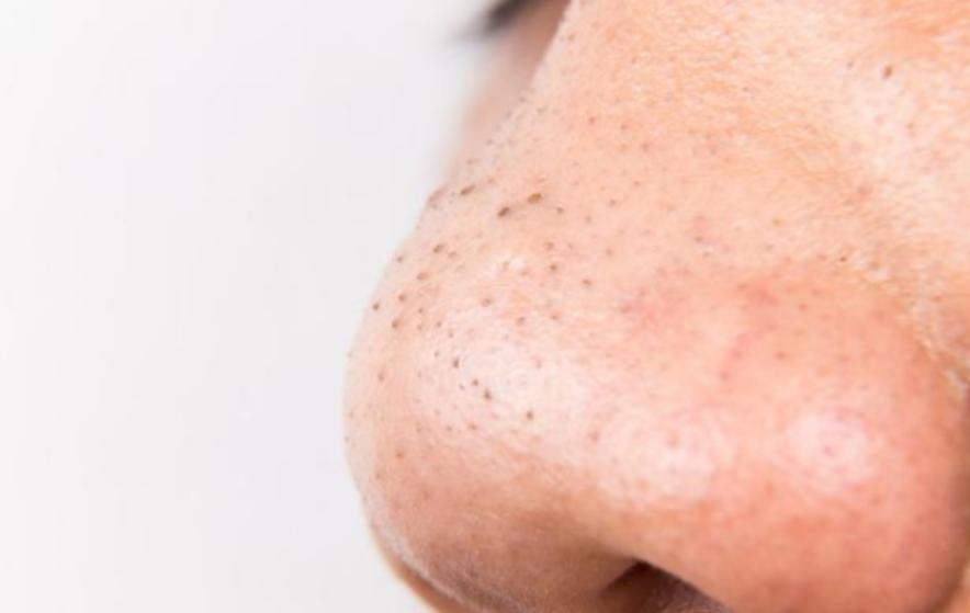 如果脸部有螨虫会有什么表现,脸上如果有螨虫该怎么办