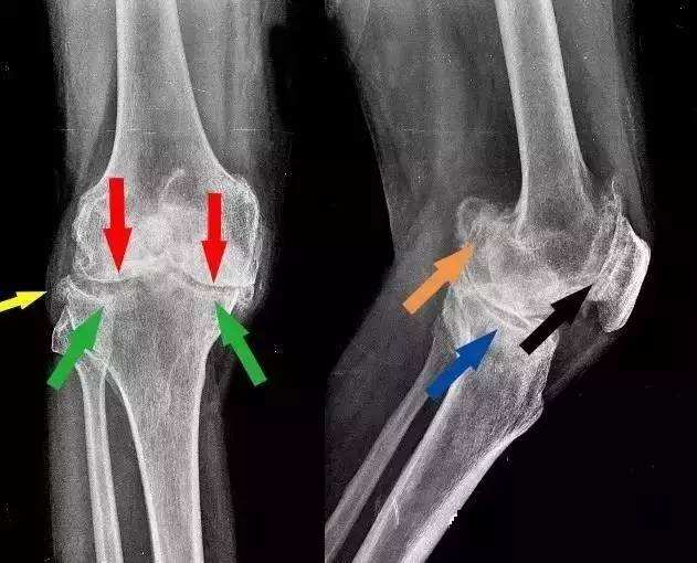 医生讲贴膏药可以治愈骨病,药品的宣传可以消除骨刺是真的吗