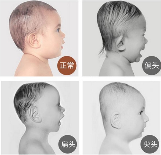 医院给宝宝调整头型,三种方法帮助宝宝塑造漂亮的头型