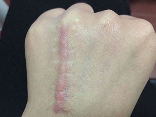 白色的凸起的疤痕增生怎么治,白色凸起疤痕是什么