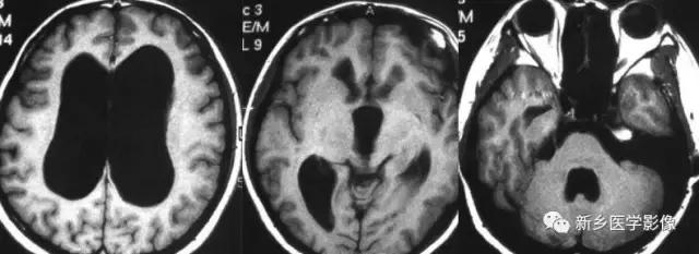 脑室为什么会扩张,脑室为什么会变小