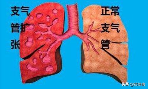 结核病的各种合并症和并发症,结核病有哪些并发症